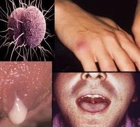 GONORRHEA: CLINICAL MANIFESTATION, DIAGNOSIS AND TREATMENT